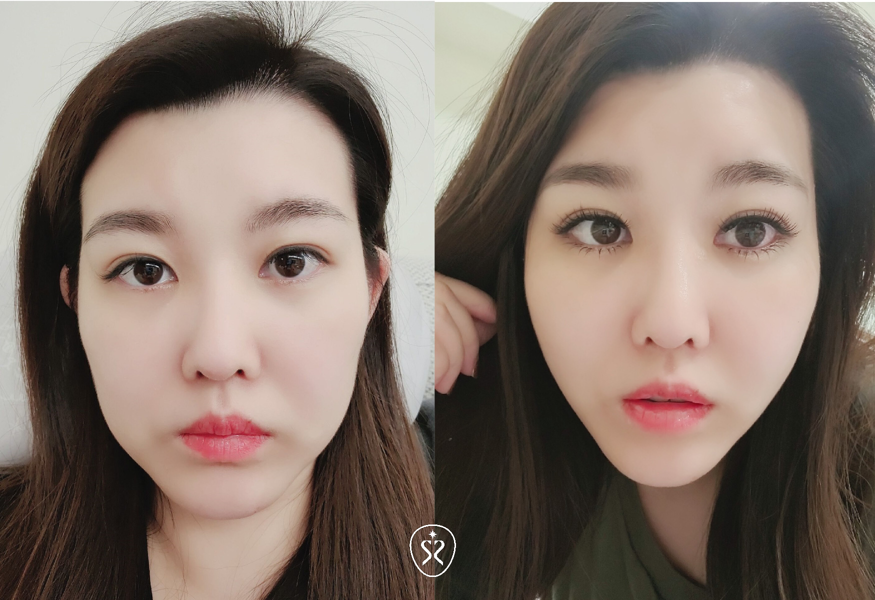 術前驚人嘴邊肉與術後一個月精緻小V臉對比